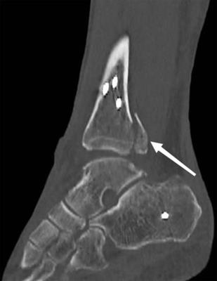 Frontiers | Chest x-ray feature of venous air embolism in orthopedic ...