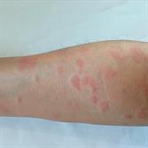 Biomarkers in Urticaria | Frontiers Research Topic