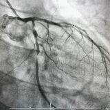 Advances and Dilemmas in Contemporary Management of Chronic Coronary ...