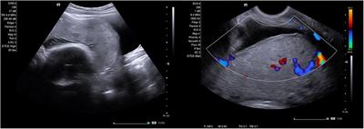 Frontiers | Absence of abnormal vascular changes on prenatal imaging ...