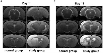 Frontiers  Intrafamilial variability in SLC6A1-related neurodevelopmental  disorders