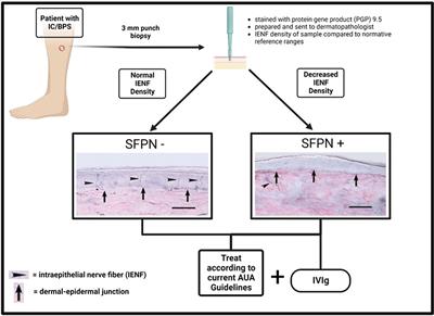 Frontiers | Small fiber polyneuropathy: A new therapeutic target in ...