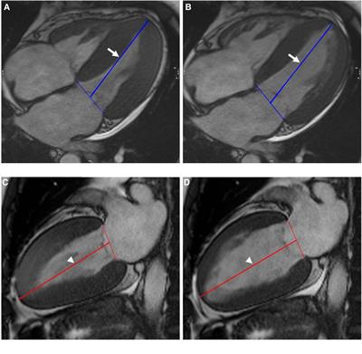 Frontiers  Left Ventricular Strains and Myocardial Work in Adolescents  With Anorexia Nervosa