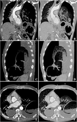 Frontiers | A rare and severe complication after minimally invasive ...