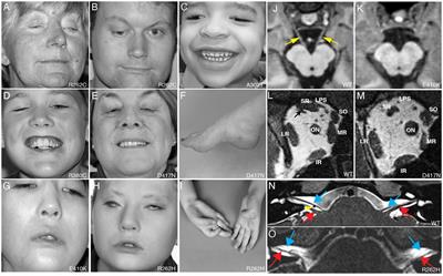 Frontiers  Intrafamilial variability in SLC6A1-related neurodevelopmental  disorders