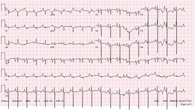 Frontiers | Case Report: Sustained ventricular arrhythmia in a child ...