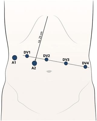 Port Placement for Gastric Bypass -SAGES Image Library