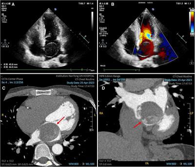 Frontiers | Case Report: Giant left atrial cystic tumor: myxoma or ...