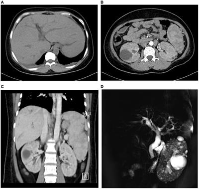 Frontiers | Case report: Rare genetic liver disease - a case of ...