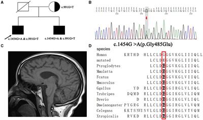 Frontiers | A novel variant of PLA2G6 gene related early-onset ...