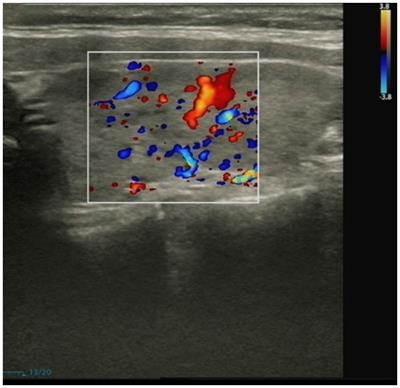 Stiff-person syndrome in association with Hashimoto’s thyroiditis: a case report