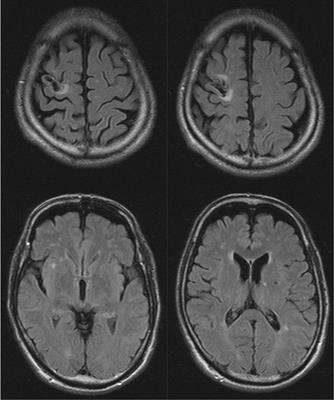Case report: Gait-induced palilalia in a patient with hemiplegia due to cerebral infarction