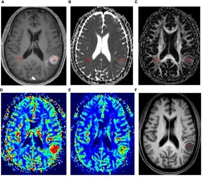 Noninvasive Assessment of Ki-67 Labeling Index in Glioma Patients based ...