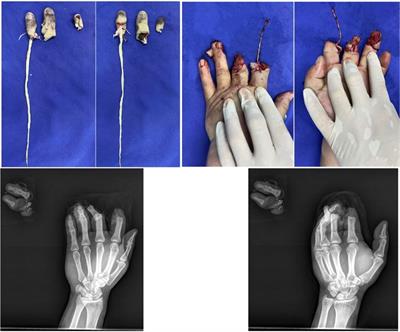 Frontiers | Transplantation of a free fillet flap from discarded ...