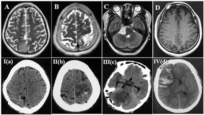 Frontiers | Hemorrhagic cerebral venous infarction after vein injury ...