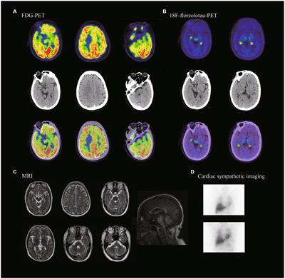 Frontiers | A novel MAPT variant (E342K) as a cause of familial ...