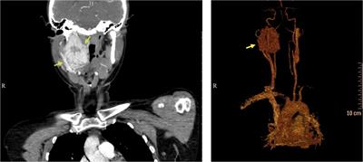 Frontiers | Genetic changes in the FH gene cause vagal paraganglioma