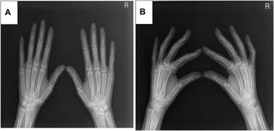 Frontiers | Case report: Clinical, imaging, and genetic characteristics ...