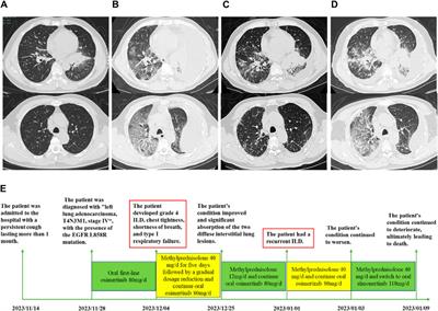 Case report: EGFR-TKI rechallenge after osimertinib-induced interstitial lung disease: a case report and literature review