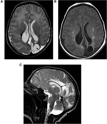 COL4A1 gene mutations and perinatal intracranial hemorrhage in neonates: case reports and literature review