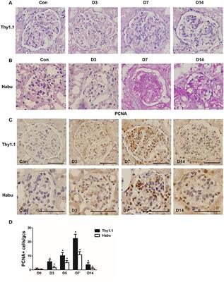 mesangiale proliferative Glomerulonephritis