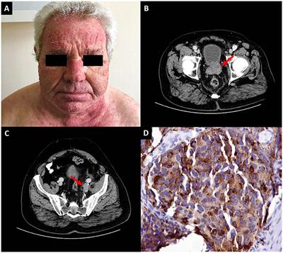 Frontiers  P2RY12-Inhibitors Reduce Cancer-Associated Thrombosis and Tumor  Growth in Pancreatic Cancers