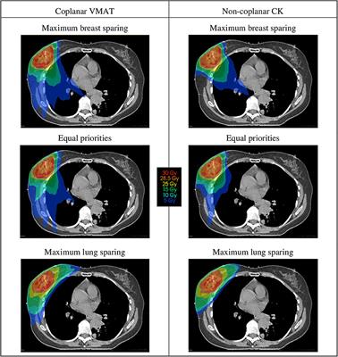 External-beam partial breast irradiation in a supine versus prone position  after breast-conserving surgery for Chinese breast cancer patients