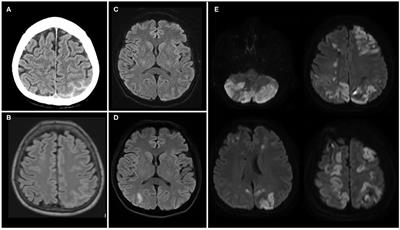 Reversible Cerebral Vasoconstriction Syndrome