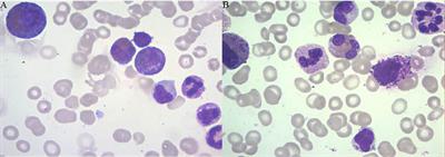 Frontiers | Case Report: Roxadustat in Combination With Rituximab Was ...