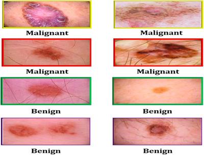 melanoma skin cancer - List of Frontiers' open access articles