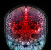 Cryptogenic Ischemic Stroke | Frontiers Research Topic