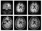 Progressive Multifocal Leukoencephalopathy: From Risk Stratification to ...