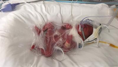 Preemie ventilator sale