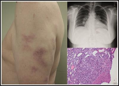 Sarcoidosis – the great mimicker | Frontiers Research Topic