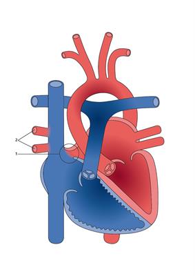 sinus venosus asd